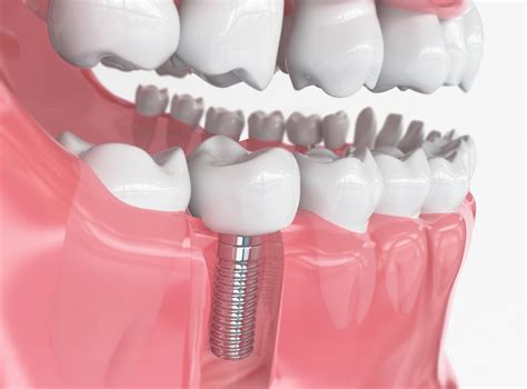  Urethane: Um Material Versátil para Implantes Dentários de Alta Resistência e Durabilidade!